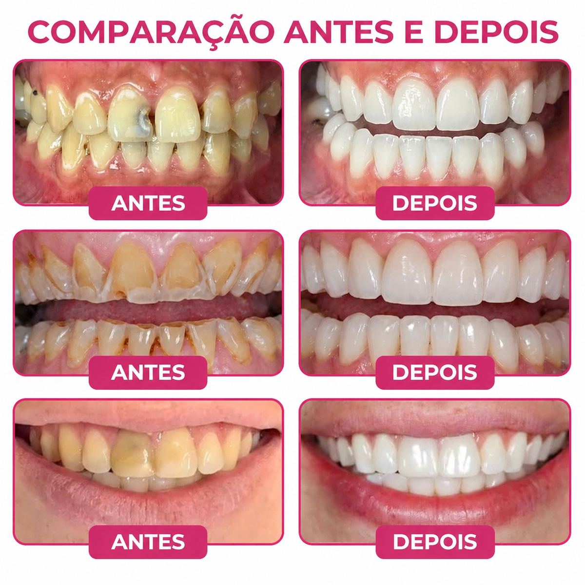 🇵🇹 Bremvik®🎐🎐 DenPerm Gel Natural Reparador de Cáries e Restaurador do Esmalte Dentário