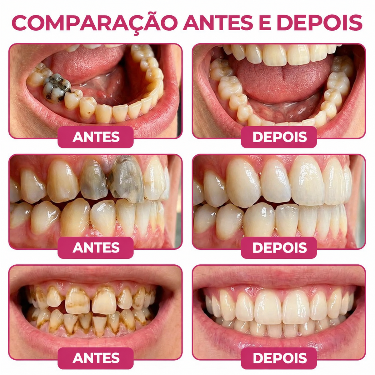 🇵🇹 Bremvik®🎐🎐 DenPerm Gel Natural Reparador de Cáries e Restaurador do Esmalte Dentário