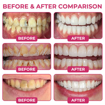 🇺🇸Bremvik® DenPerm Cavity-Repair Natural Enamel Filling Gel