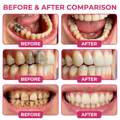 🇺🇸Bremvik® DenPerm Cavity-Repair Natural Enamel Filling Gel